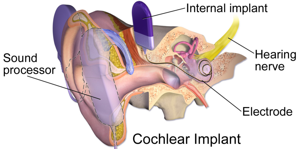 cochlear implant technology